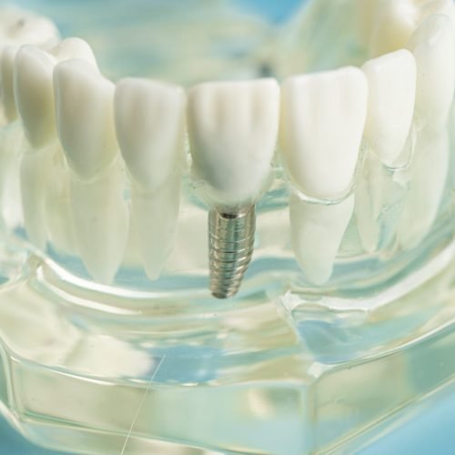 Dental implant, artificial tooth roots into jaw, root canal of dental treatment, gum disease, teeth model for dentist studying about dentistry.