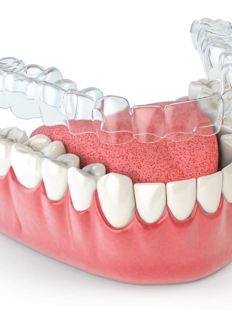 Invisalign invisible retainer  or braces with lawer jaw islated on white. 3d illustration